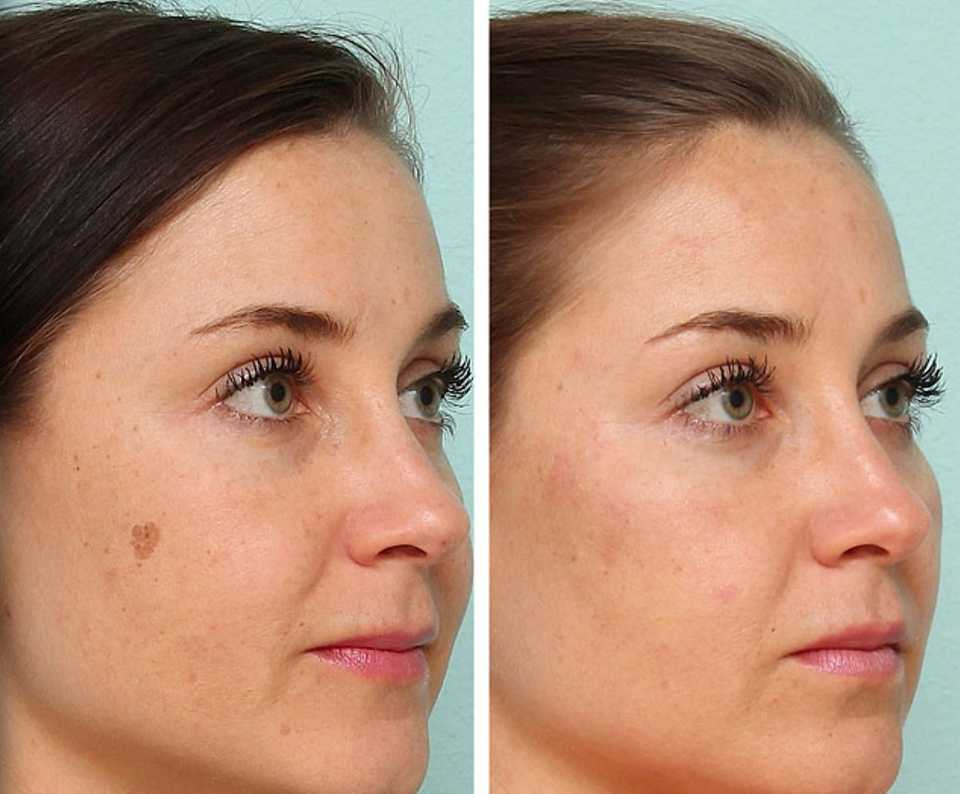 Лазерное удаление пигментных пятен до и после