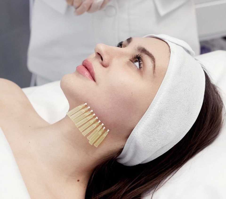 лифтинг с помощью нитей Дермафил Хеппи Лифт