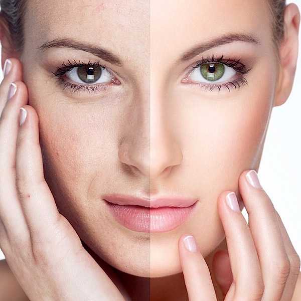 Видимые результаты RF лифтинга