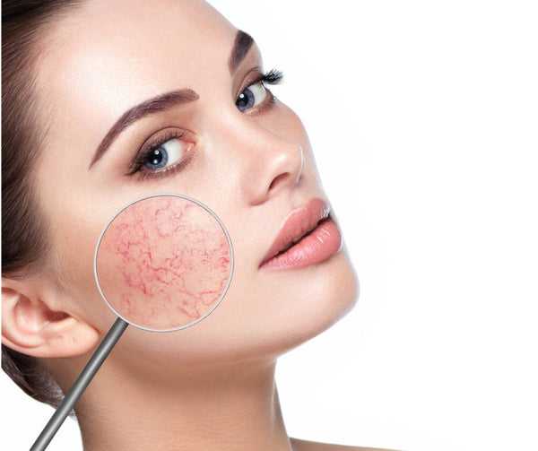 Удаление сосудистой сетки на лице