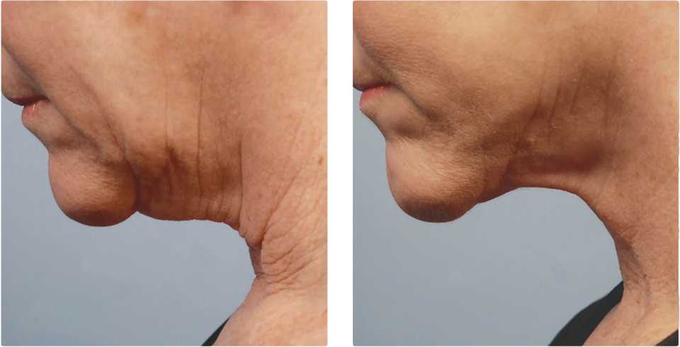 результат лифтинга шеи после процедуры RF-лифтинга