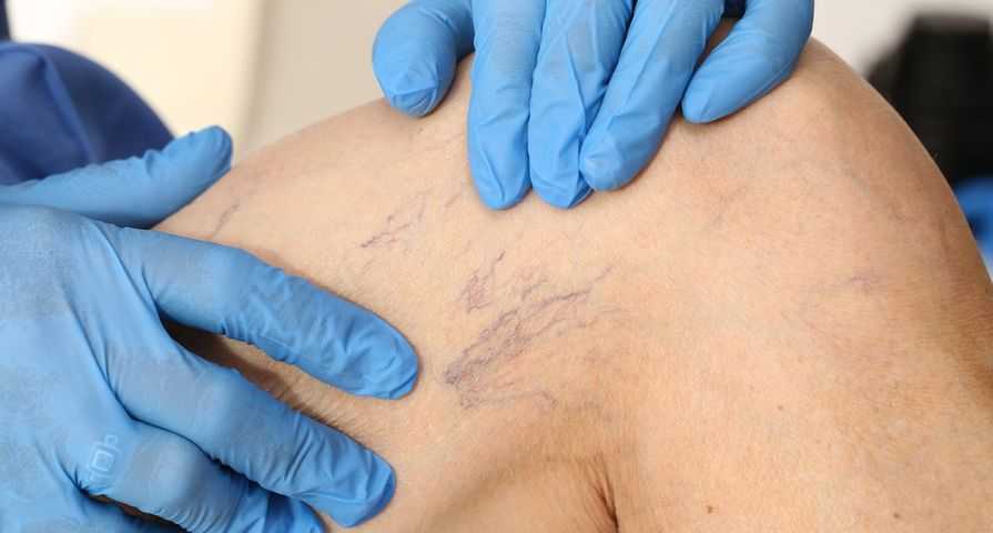 Сосуды на ногах