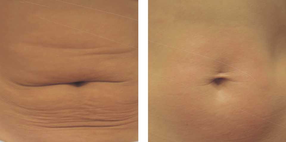 результат лифтинга после безоперационной липосакции