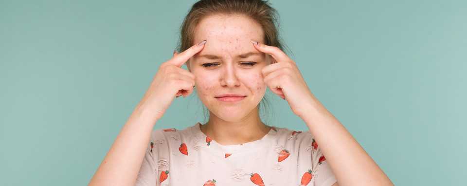 Подросток с угревой сыпью на лице