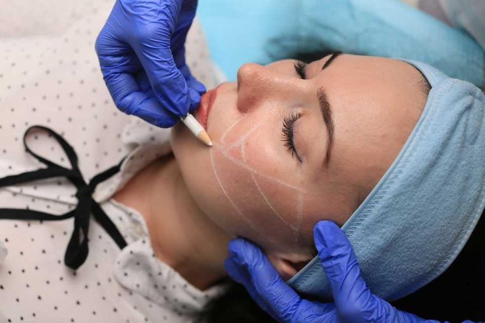 Врач производит разметку на лице перед процедурой векторного лифтинга