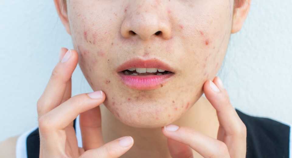 комедоны на лице