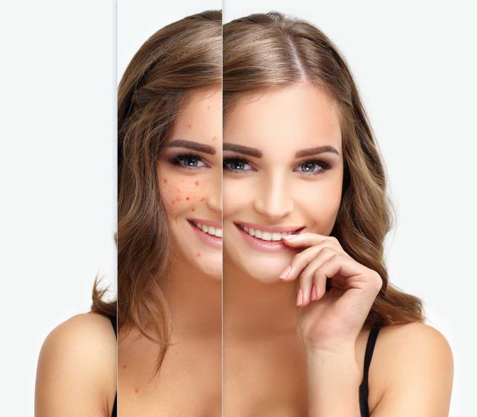 Избавление от прыщей на лице