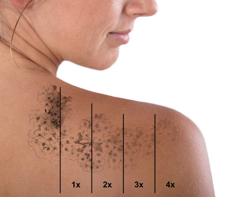 Удаление татуировки за несколько сеансов