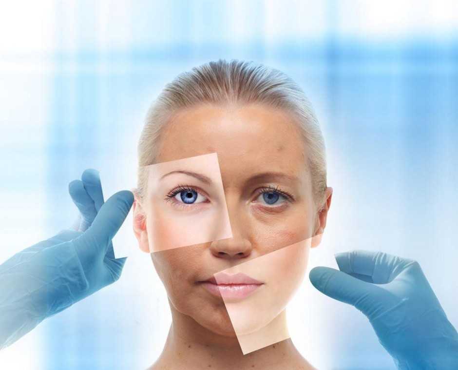 Длительность эффекта СМАС лифтинга