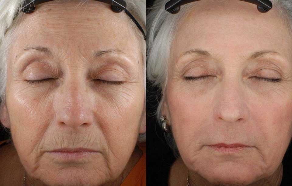 Эффективность применения фракционного лазерного омоложения до и после