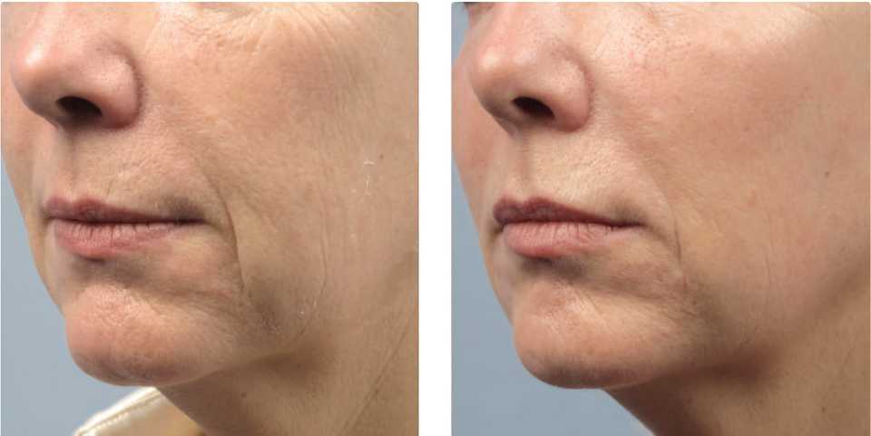результат лифтинга лица после процедуры RF-лифтинга