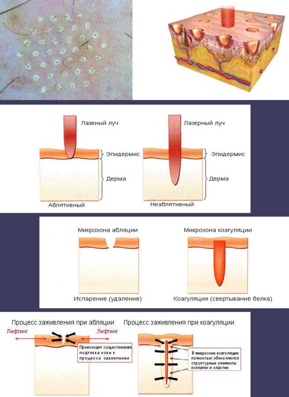 Процесс лазерного омоложения кожи